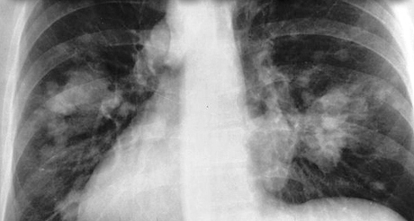 Smog lung-damage2.jpg